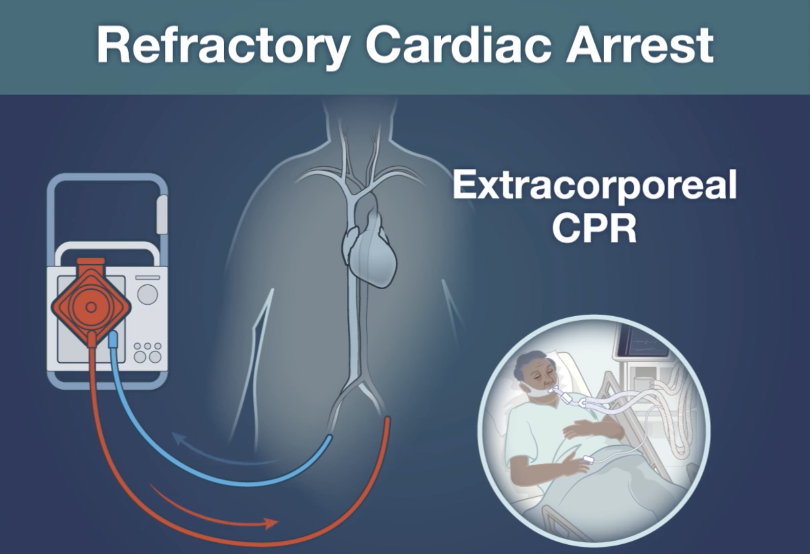 INCEPTION: Early Extracorporeal-CPR for refractory OHCA